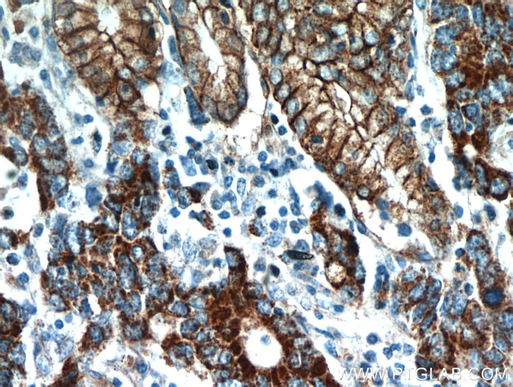 IHC staining of human stomach cancer using Claudin 18 polyclonal antibody