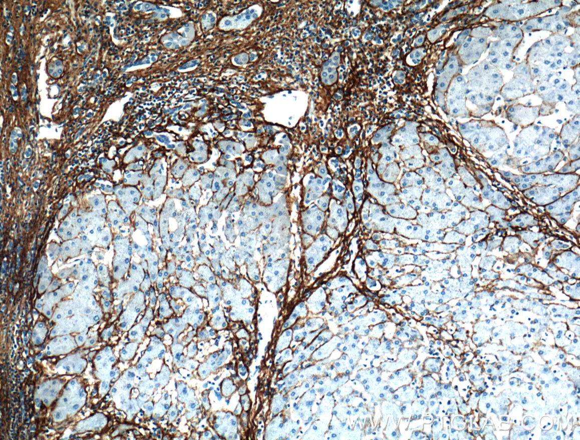 Immunohistochemical analysis of paraffin-embedded human hepatocirrhosis tissue slide using Collagen Type III antibody