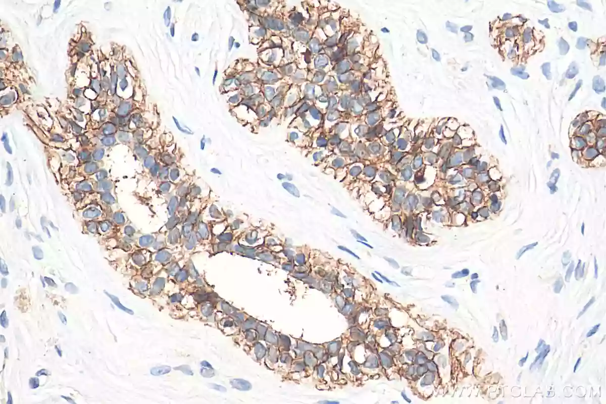 IHC staining of human breast cancer using E-cadherin polyclonal antibody