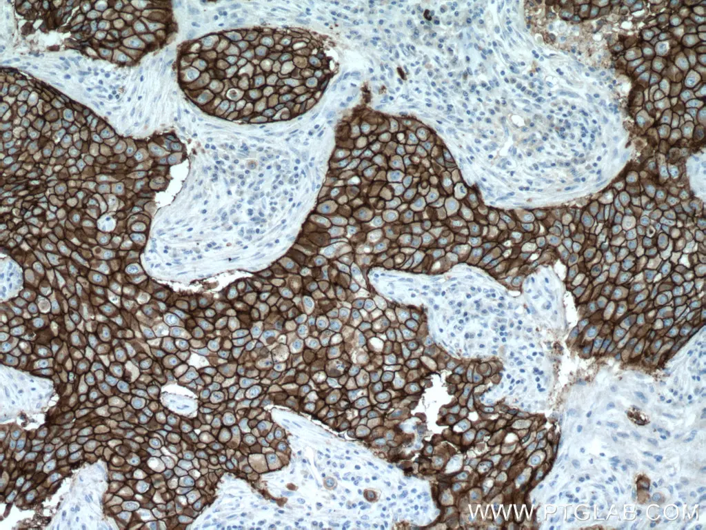 IHC staining of human breast cancer using HER2/ErbB2 Polyclonal antibody