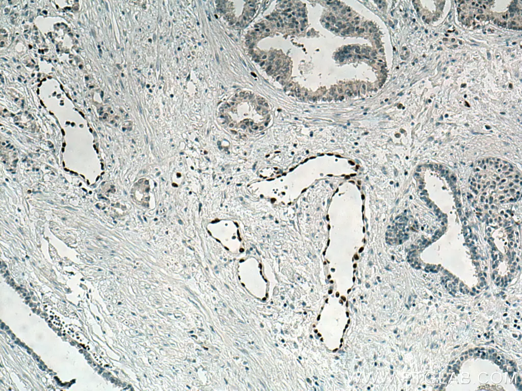 IHC staining of human prostate cancer using ERG polyclonal antibody