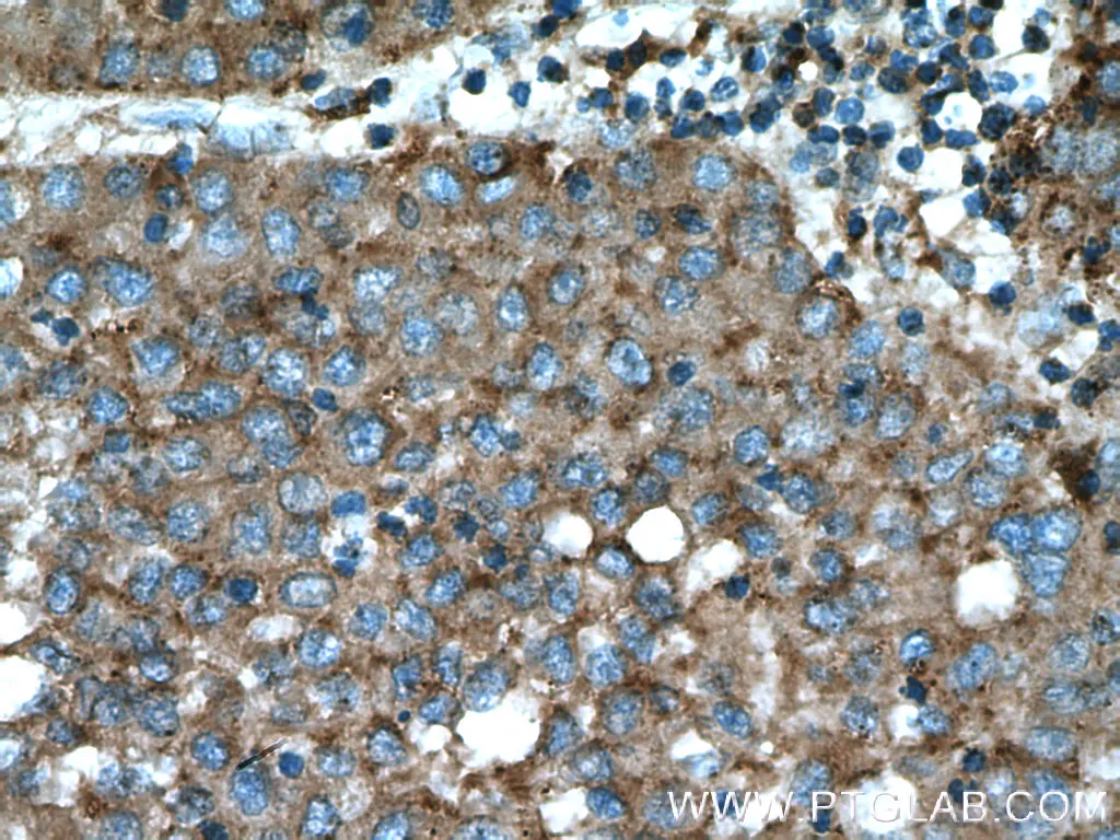 Immunohistochemical analysis of paraffin-embedded human liver cancer tissue slide using 15518-1-AP (Beta galactosidase Antibody) 