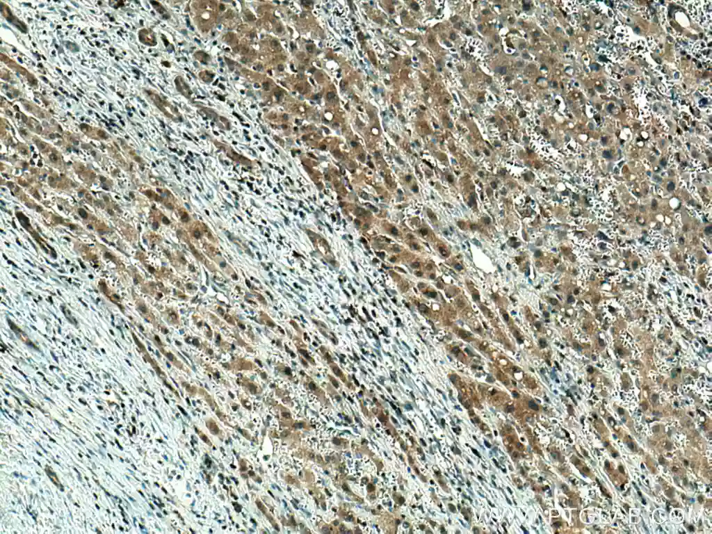 Immunohistochemical (IHC) analysis of paraffin-embedded human liver cancer tissue slide using 67763-1-Ig (GPX4 antibody) at dilution of 1:2000 (under 10x lens).