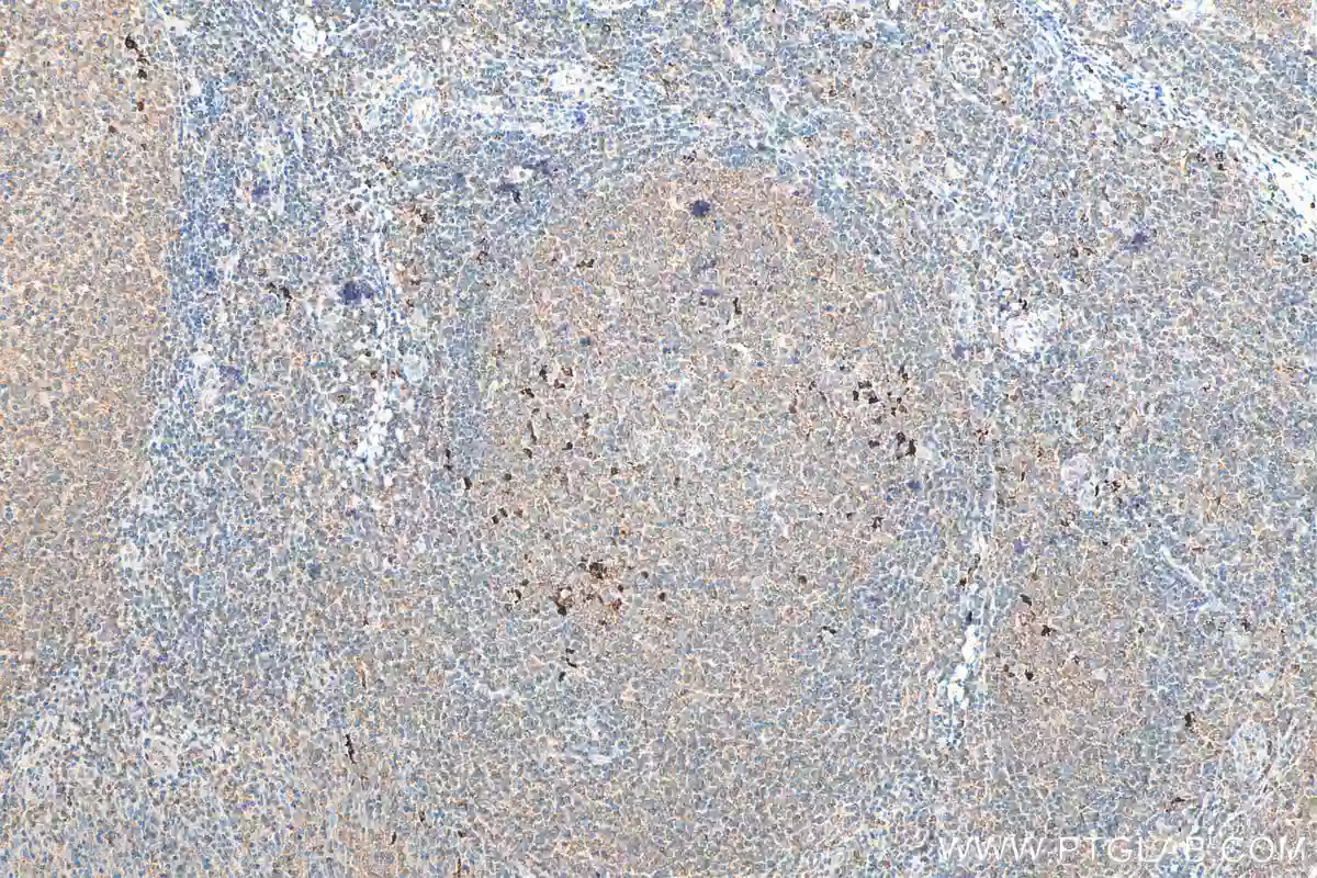 Immunohistochemical (IHC) analysis of paraffin-embedded human tonsillitis tissue slide using 16806-1-AP (IL-1 Beta antibody) at dilution of 1:200 (under 10x lens). 
