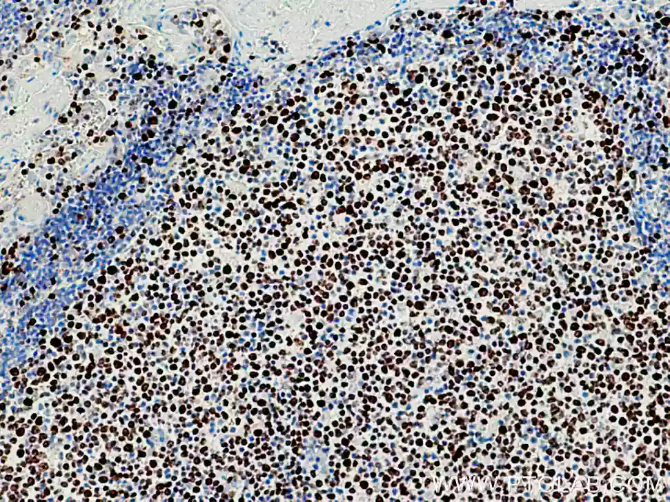 Immunohistochemical analysis of paraffin-embedded human tonsillitis tissue slide using 27309-1-AP (KI67 antibody)