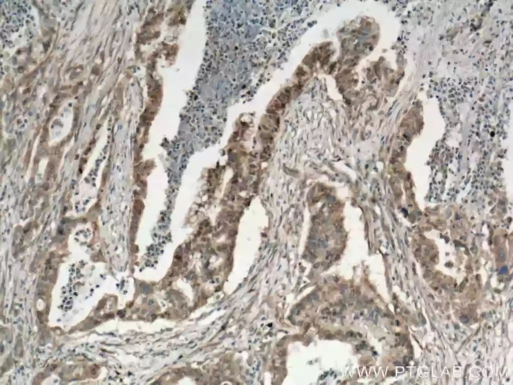 IHC staining of human pancreas cancer using KRAS polyclonal antibodu