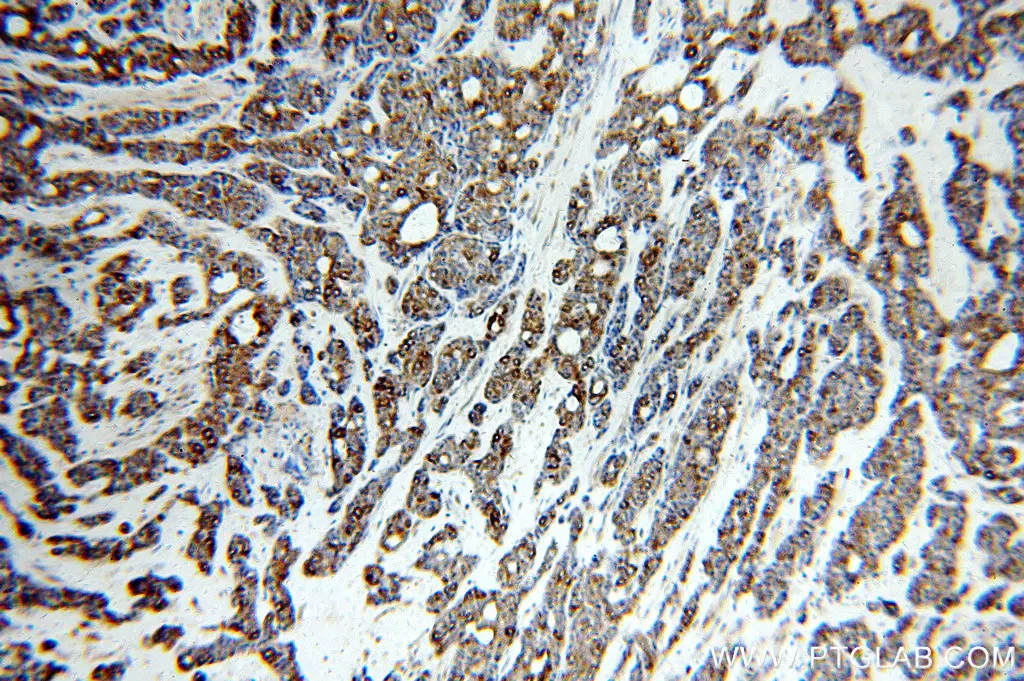 IHC analysis of paraffin-embedded human cervical cancer KRT7 Specific antibody