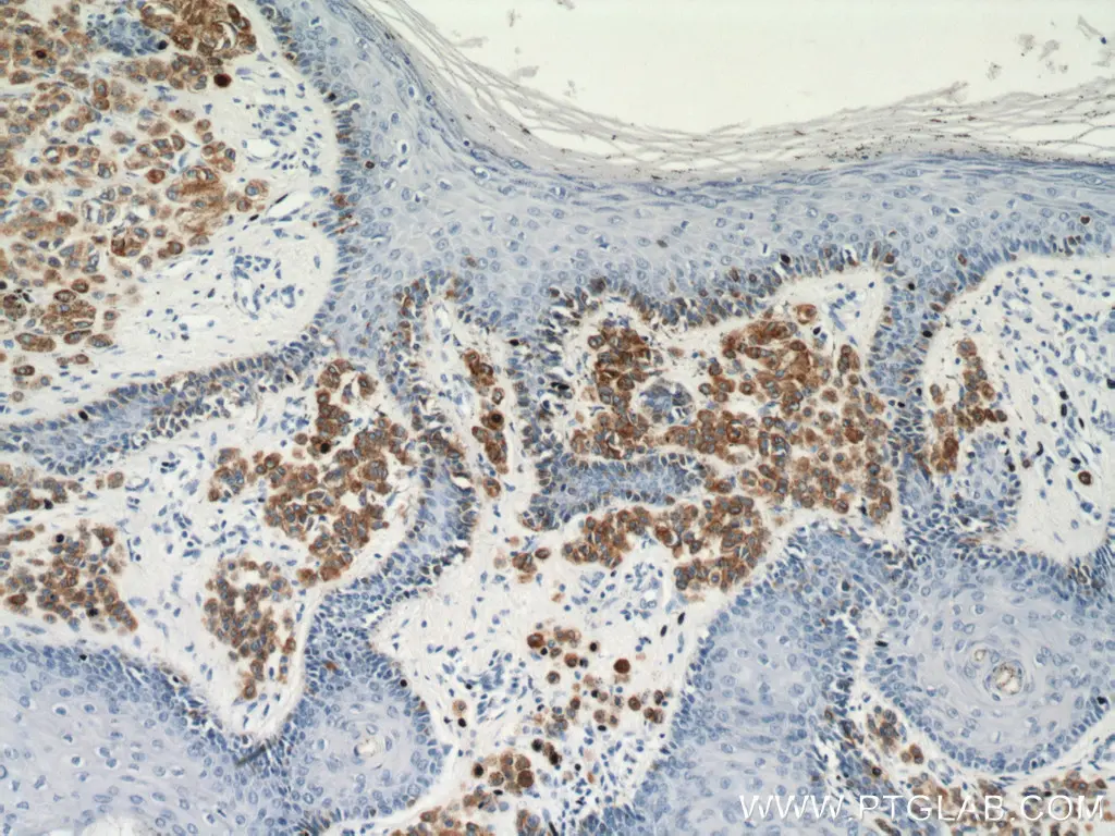 IHC staining of human malignant melanoma using Melan-A polyclonal antibody