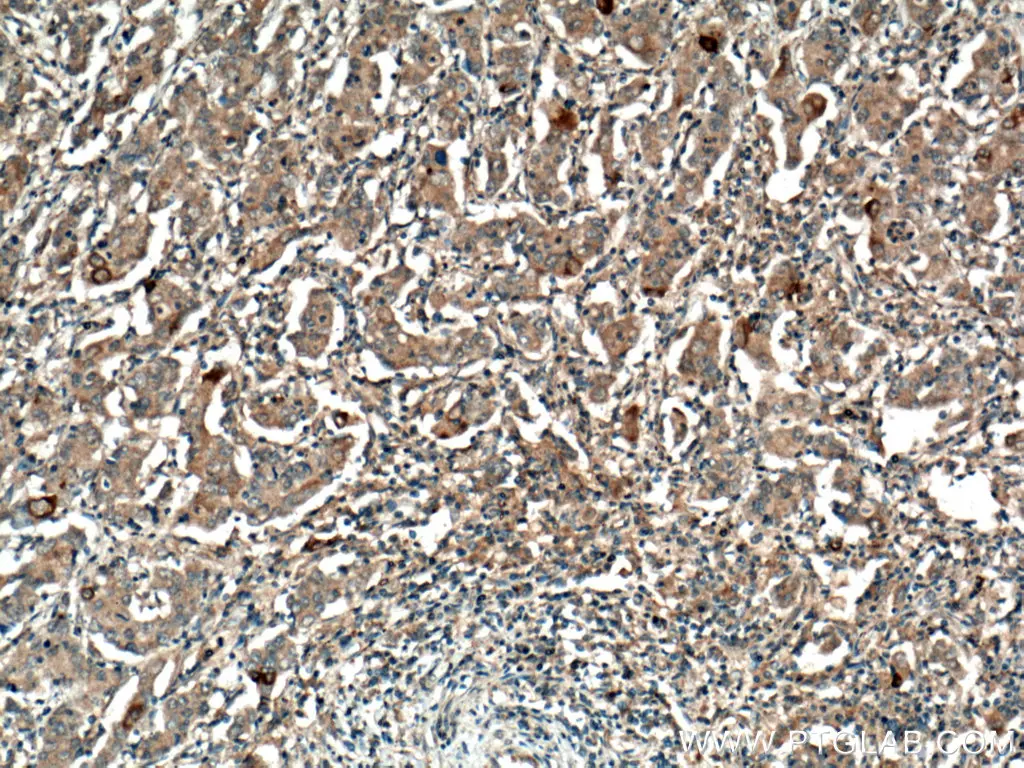 IHC staining of human stomach cancer using MMP7 polyclonal antibody