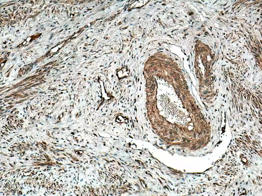 IHC analysis of paraffin-embedded human cervical cancer tissue slide using MMP9 (N-terminal) antibody