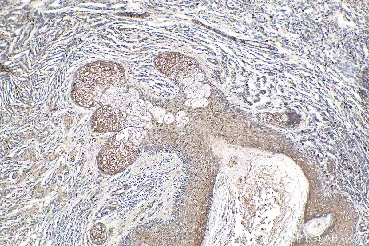 IHC staining of human malignant melanoma using NRAS-specific polyclonal antibody