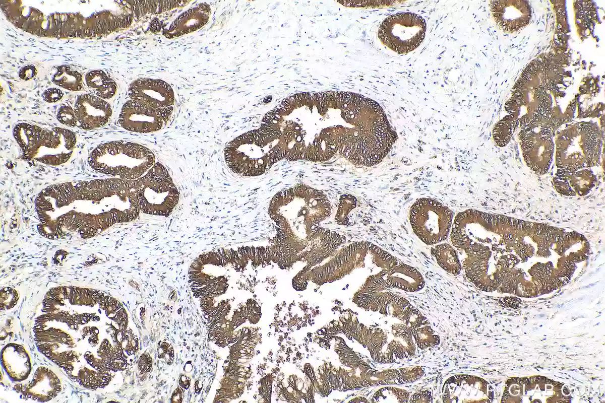 Immunohistochemistry staining of human pancreas cancer using NRF2, NFE2L2 Recombinant antibody