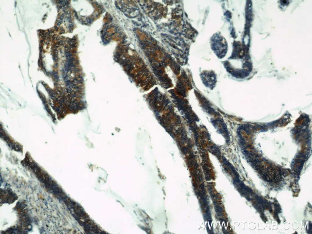 IHC staining of human colon cancer using Osteopontin (OPN) polyclonal antibody