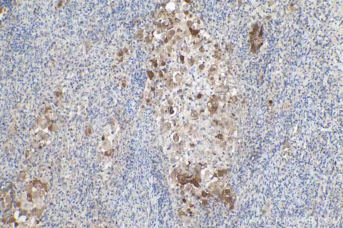 IHC analysis of paraffin-embedded human cervical cancer using p16INK4a antibody