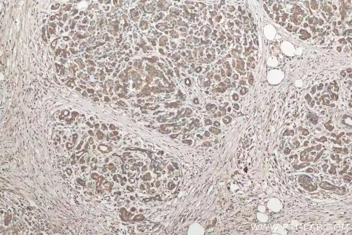 IHC staining of human pancreas cancer using PERK/EIF2AK3 polyclonal antibody