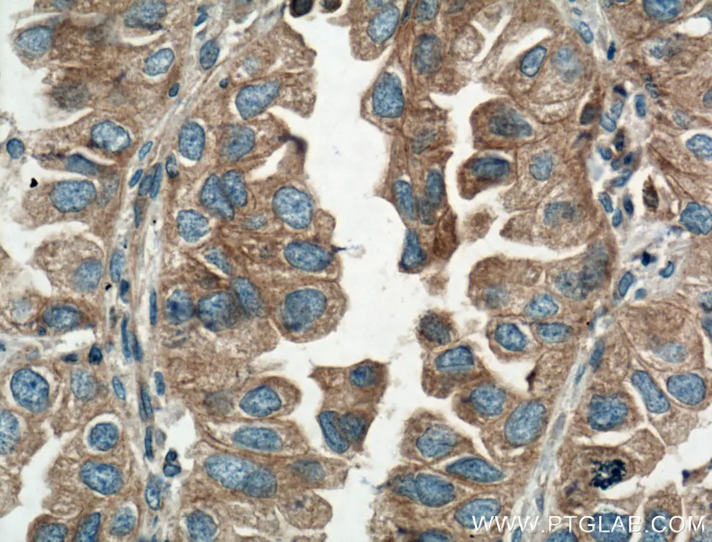 Immunohistochemical analysis of paraffin-embedded human lung cancer tissue slide using 10308-1-AP (AMPK beta 1 antibody