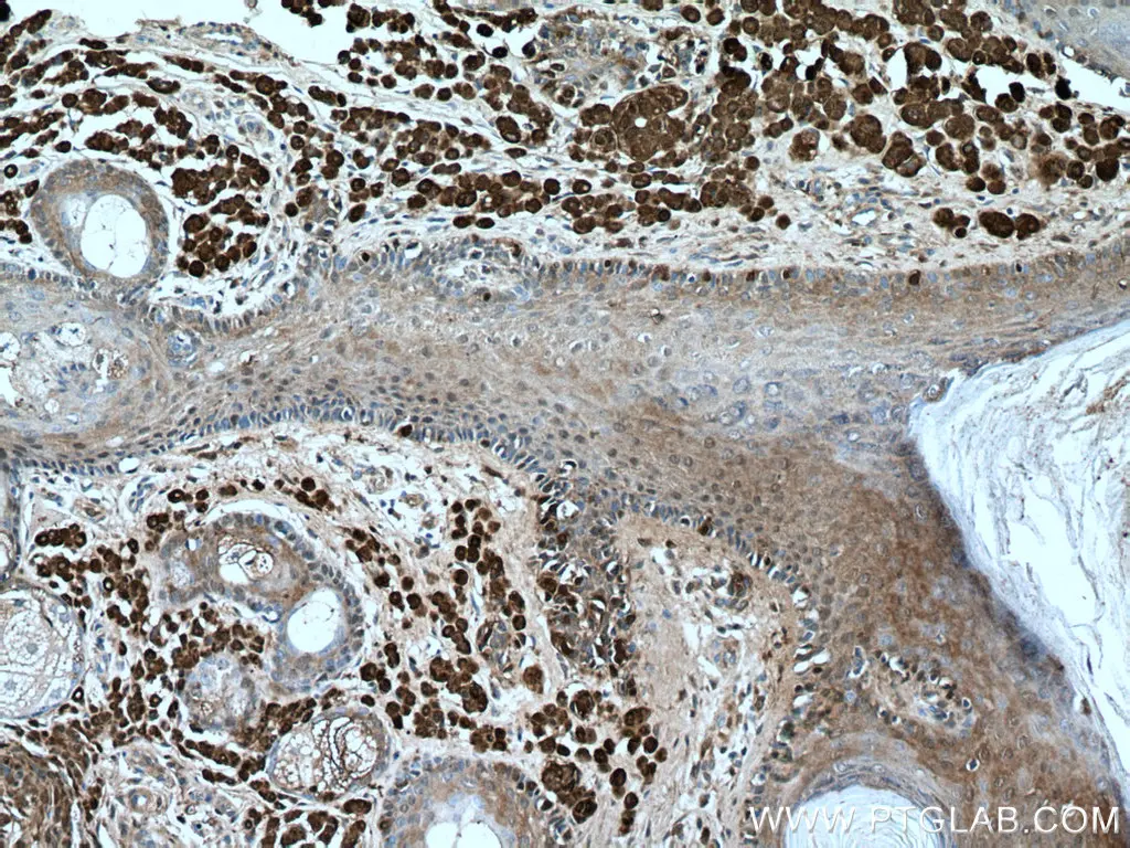 IHC staining of human malignant melanoma using S100 Beta polyclonal antibody