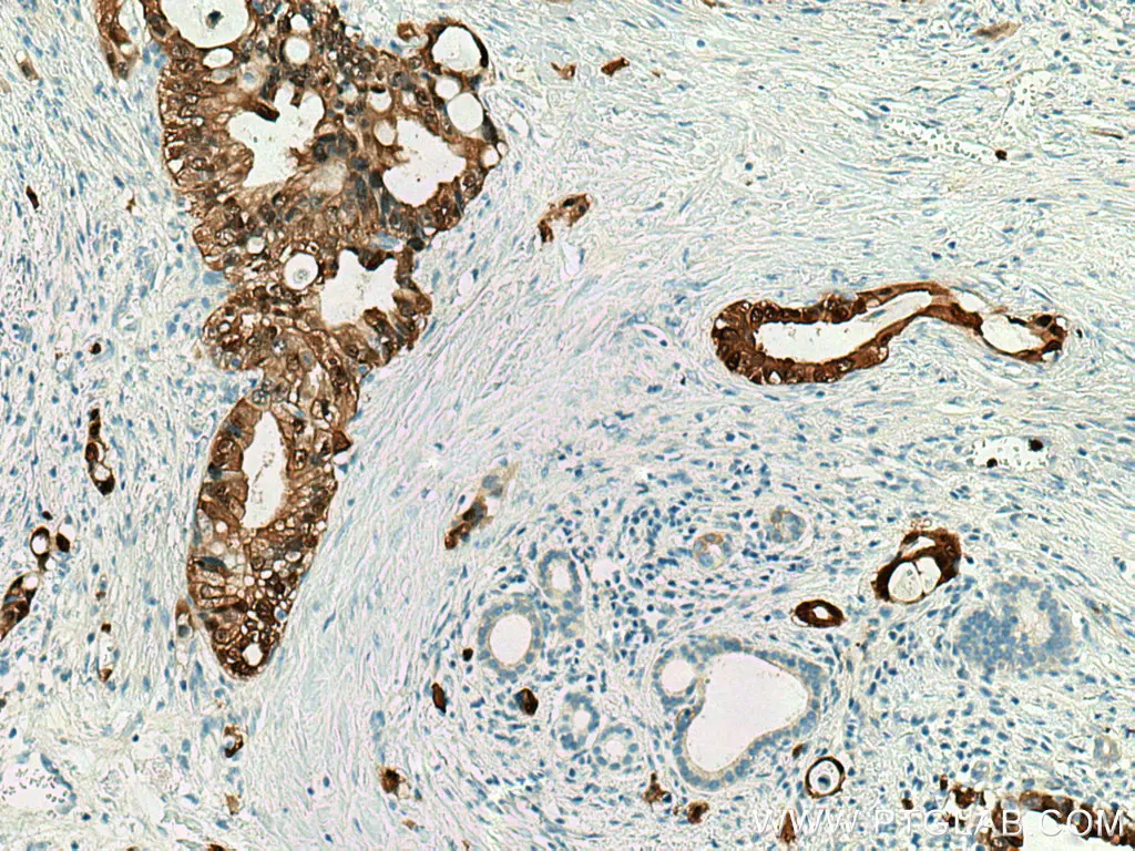 IHC staining of human pancreas cancer using S100P polyclonal antibody