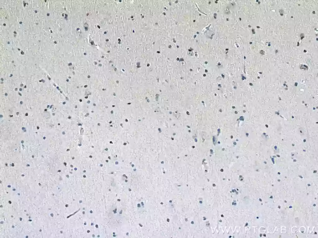 Immunohistochemical analysis of paraffin-embedded human gliomas tissue slide using Proteintech's SOX2 antibody (11064-1-AP) at dilution of 1:200 (under 10x lens)