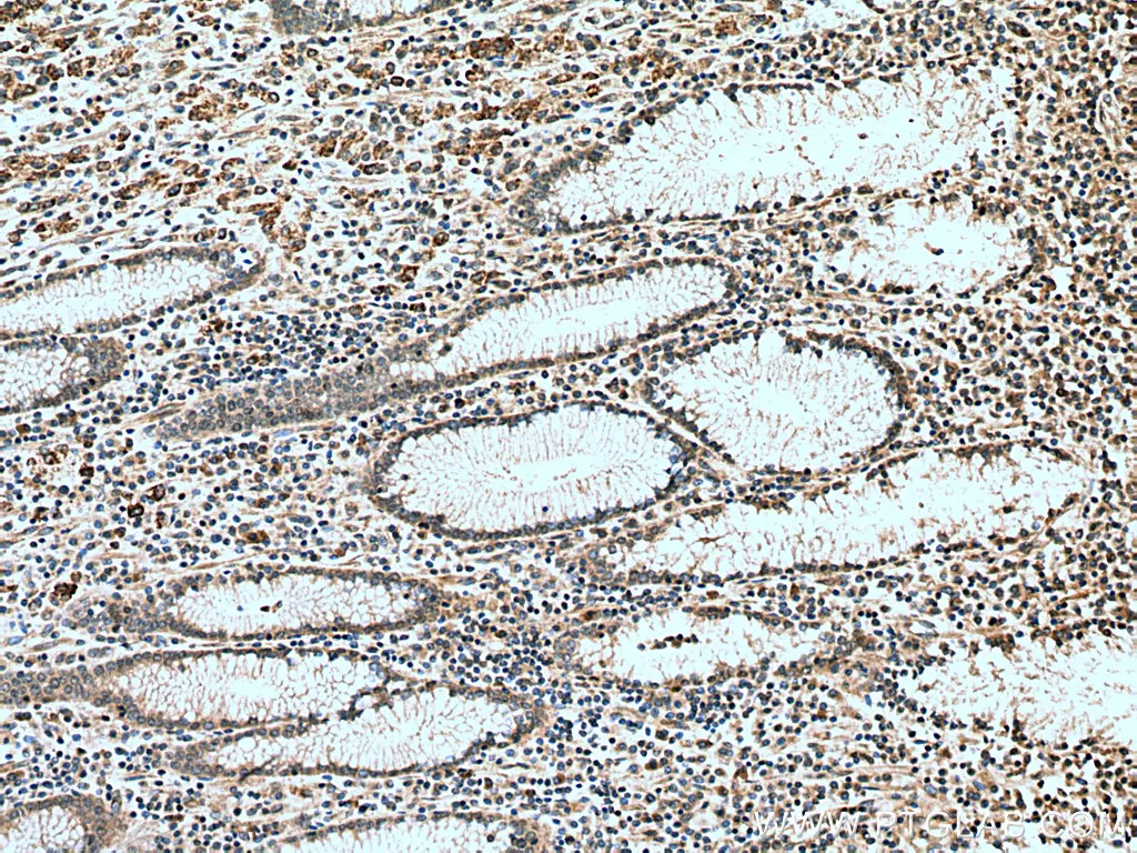 IHC staining of human stomach cancer using SURVIVIN polyclonal antibody
