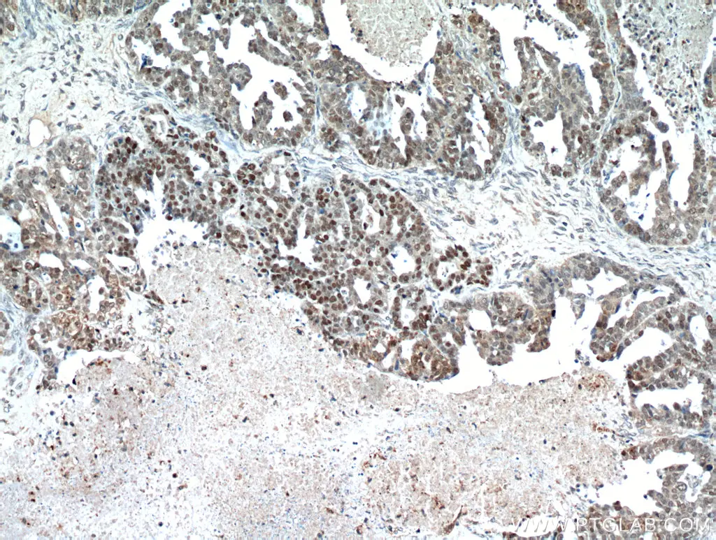 IHC staining of human ovary tumor using p53 polyclonalantibody