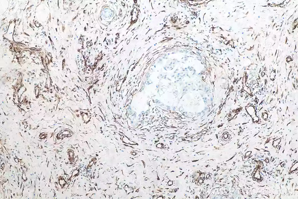 Immunohistochemistry staining of human breast cancer using Vimentin Recombinant antibody
