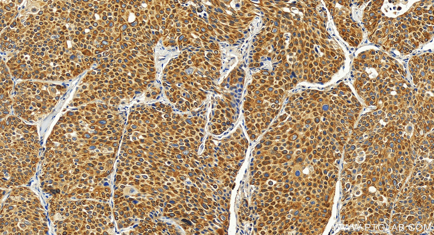 Immunohistochemistry (IHC) staining of human lung cancer tissue using SLC7A11/xCT Polyclonal antibody (26864-1-AP)